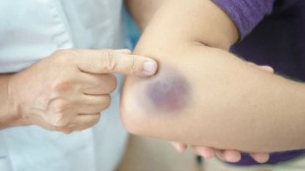 10 Shocking Spiritual Meanings of Bruises